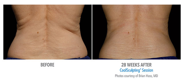 Before and After Coolsculpting