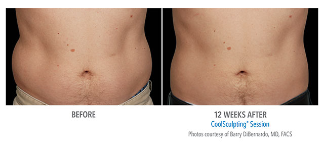 Before and After Men's Coolsculpting