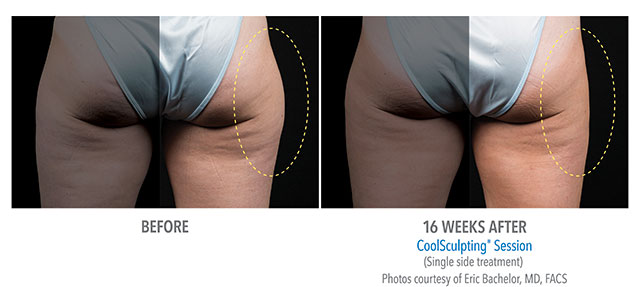 Before and After Coolsculpting