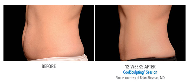 Before and After Coolsculpting
